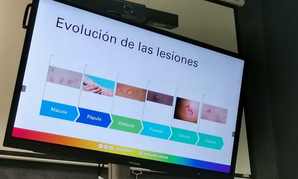 Realiza SETAC promoción y prevención sobre Viruela Símica en CUCosta